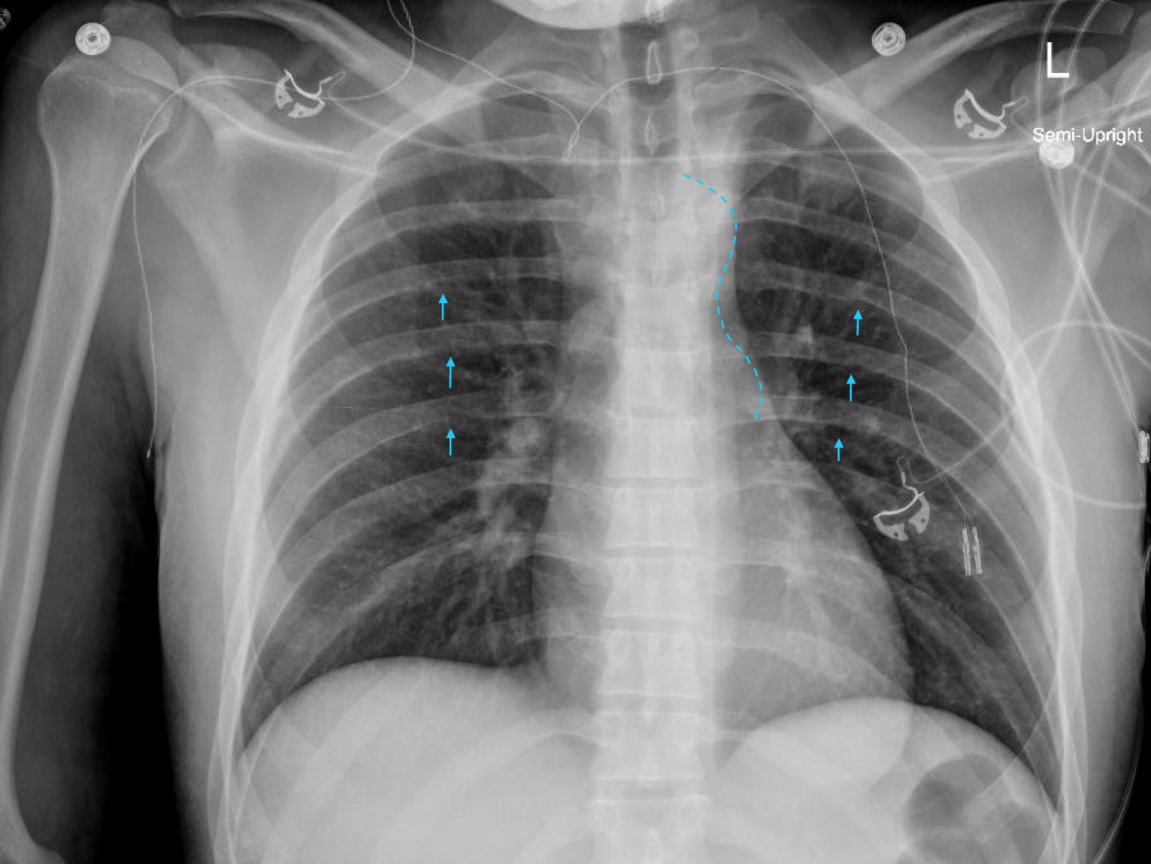 Subarachnoid Hemorrhage Unmasks Aortic Coarctation In A Young Man ...