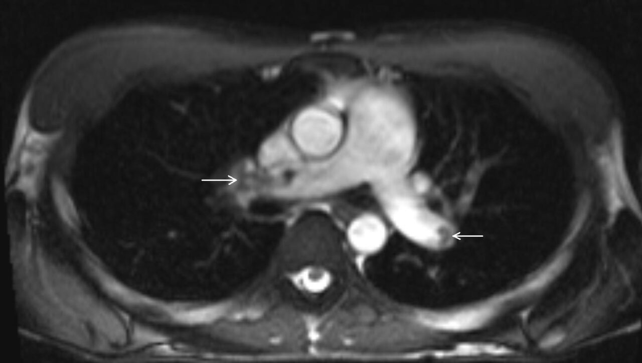 An unusual cause of chest pain in a young patient: chronic pulmonary ...